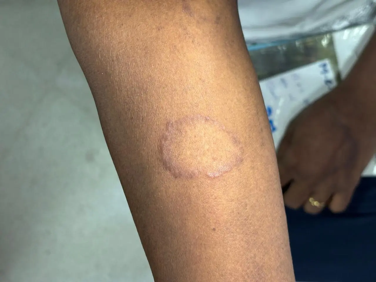 Ringworm Infection