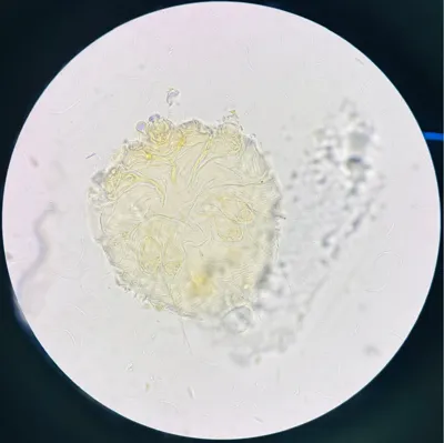 Sarcoptes scabiei under microscope