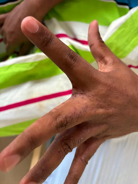 Scabies image one