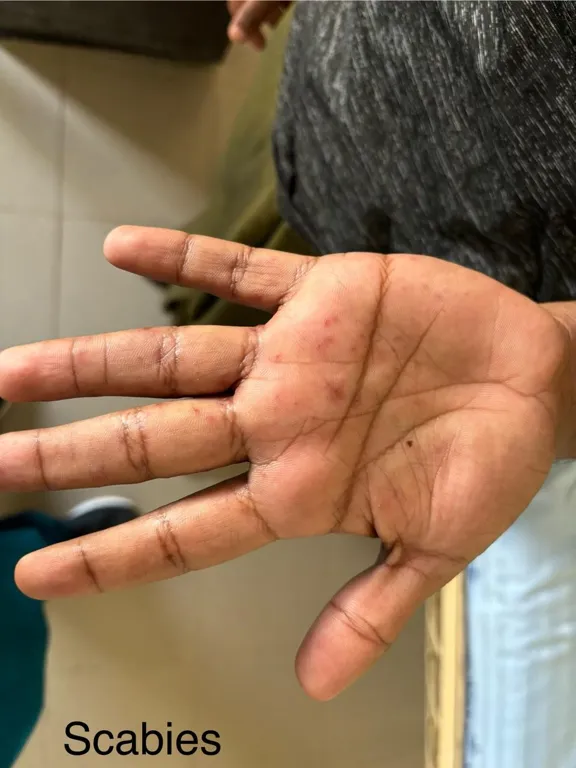 Scabies image three