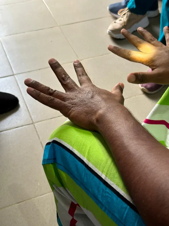 Scabies image two