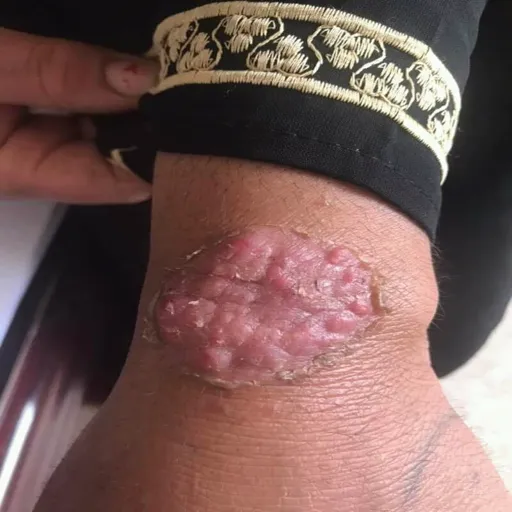 Majocchi granuloma